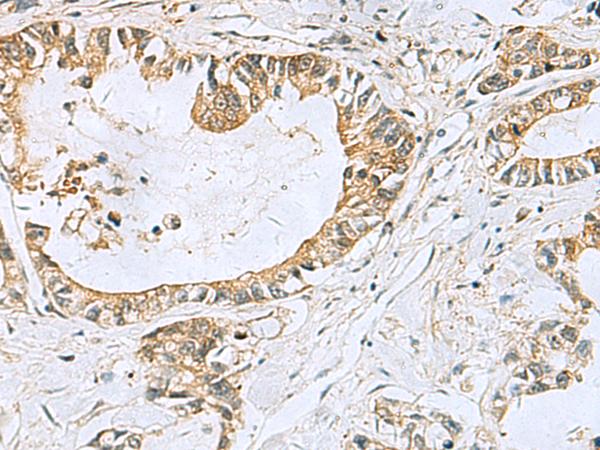 TUBD1 / Tubulin Delta Antibody - Immunohistochemistry of paraffin-embedded Human gastric cancer tissue  using TUBD1 Polyclonal Antibody at dilution of 1:70(×200)