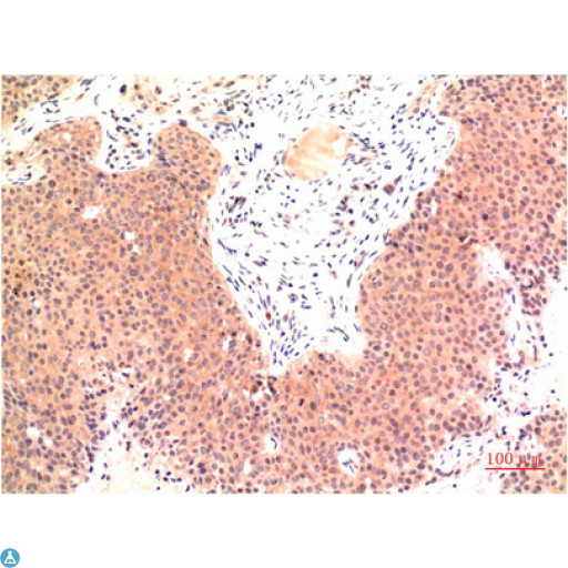 TUBE1 / Tubulin Epsilon Antibody - Immunohistochemistry (IHC) analysis of paraffin-embedded Human Colon Carcinoma Tissue using Epsilon Tubulin Mouse monoclonal antibody diluted at 1:200.