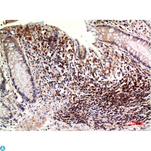 TUBE1 / Tubulin Epsilon Antibody - Immunohistochemistry (IHC) analysis of paraffin-embedded Human Colon Carcinoma Tissue using Epsilon Tubulin Mouse Monoclonal Antibody diluted at 1:200.