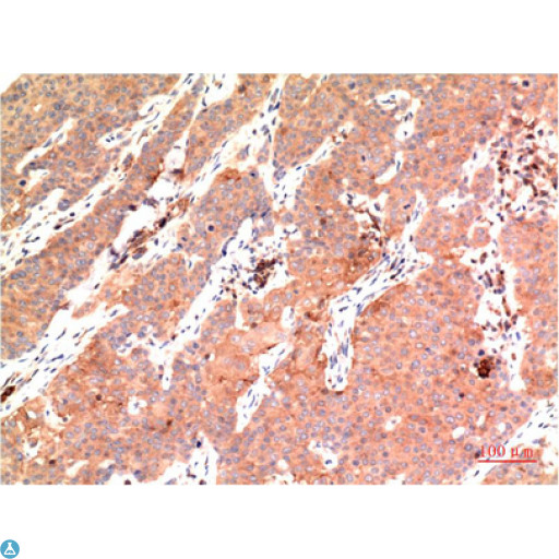 TUBE1 / Tubulin Epsilon Antibody - Immunohistochemistry (IHC) analysis of paraffin-embedded Human Breast Carcinoma Tissue using Epsilon Tubulin Mouse Monoclonal Antibody diluted at 1:200.