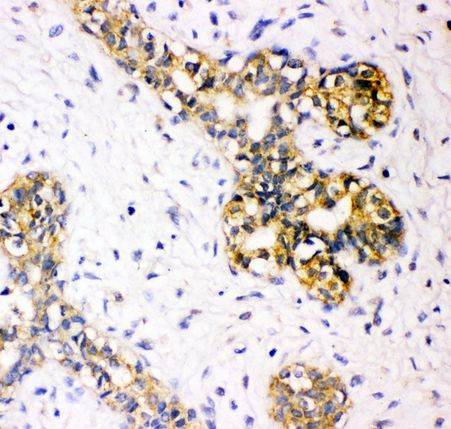 Tuberin / TSC2 Antibody - Tuberin antibody IHC-paraffin: Human Mammary Cancer Tissue.