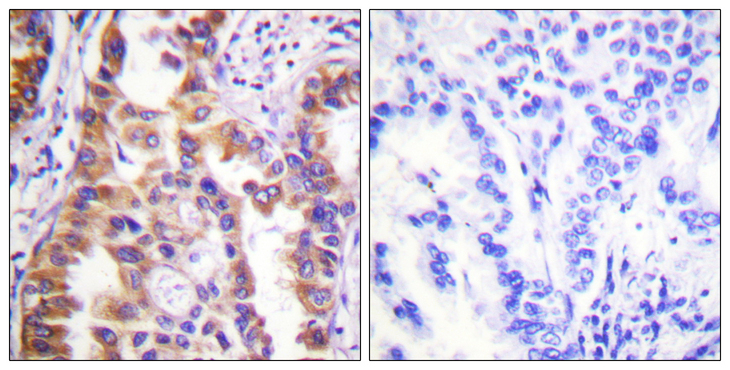 Tuberin / TSC2 Antibody - Immunohistochemistry analysis of paraffin-embedded human lung carcinoma tissue, using Tuberin/TSC2 Antibody. The picture on the right is blocked with the synthesized peptide.
