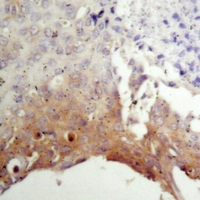 Tuberin / TSC2 Antibody - Immunohistochemical analysis of TSC2 staining in human prostate cancer formalin fixed paraffin embedded tissue section. The section was pre-treated using heat mediated antigen retrieval with sodium citrate buffer (pH 6.0). The section was then incubated with the antibody at room temperature and detected using an HRP polymer system. DAB was used as the chromogen. The section was then counterstained with hematoxylin and mounted with DPX.