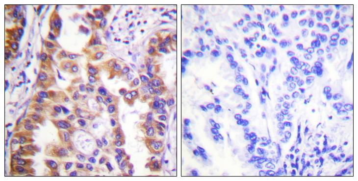 Tuberin / TSC2 Antibody - Peptide - + Immunohistochemistry analysis of paraffin-embedded human lung carcinoma tissue using Tuberin/TSC2 (Ab-939) antibody.