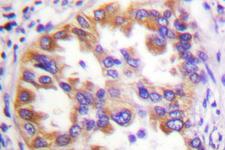 Tuberin / TSC2 Antibody - IHC of Tuberin/TSC2 (F933) pAb in paraffin-embedded human lung carcinoma tissue.