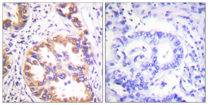 Tuberin / TSC2 Antibody - Immunohistochemistry analysis of paraffin-embedded human lung carcinoma, using Tuberin/TSC2 (Phospho-Ser939) Antibody. The picture on the right is blocked with the phospho peptide.