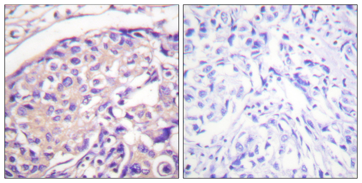 Tuberin / TSC2 Antibody - Immunohistochemistry analysis of paraffin-embedded human breast carcinoma, using Tuberin/TSC2 (Phospho-Thr1462) Antibody. The picture on the right is blocked with the phospho peptide.