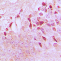 Tuberin / TSC2 Antibody - Immunohistochemical analysis of TSC2 (pT1462) staining in human brain formalin fixed paraffin embedded tissue section. The section was pre-treated using heat mediated antigen retrieval with sodium citrate buffer (pH 6.0). The section was then incubated with the antibody at room temperature and detected using an HRP conjugated compact polymer system. DAB was used as the chromogen. The section was then counterstained with hematoxylin and mounted with DPX.