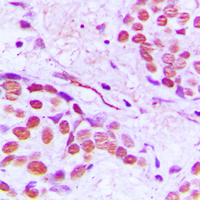 TUBG1 / Tubulin Gamma 1 Antibody - Immunohistochemical analysis of Gamma-tubulin staining in human breast cancer formalin fixed paraffin embedded tissue section. The section was pre-treated using heat mediated antigen retrieval with sodium citrate buffer (pH 6.0). The section was then incubated with the antibody at room temperature and detected using an HRP conjugated compact polymer system. DAB was used as the chromogen. The section was then counterstained with hematoxylin and mounted with DPX.