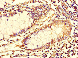 TUBG1 / Tubulin Gamma 1 Antibody - Immunohistochemistry of paraffin-embedded human colon cancer at dilution 1:100