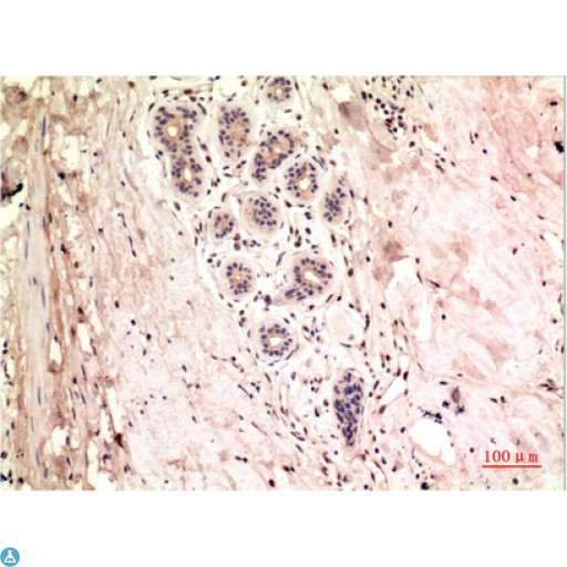 TUBG1 / Tubulin Gamma 1 Antibody - Immunohistochemistry (IHC) analysis of paraffin-embedded Human Colon Carcinoma Tissue using gamma Tubulin Mouse monoclonal antibody diluted at 1:200.