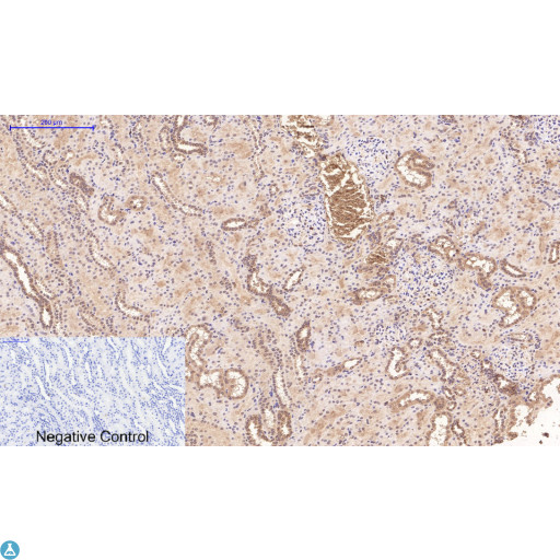 TUBG1 / Tubulin Gamma 1 Antibody - Immunohistochemical analysis of human liver cancer tissue. Anti-Gamma Tubulin at 1:200 (4°C, overnight). Antigen retrieval - Sodium Citrate pH6 (>98°C, 20min). Secondary - 1:200 (room temp, 30min). Negative control - Secondary only