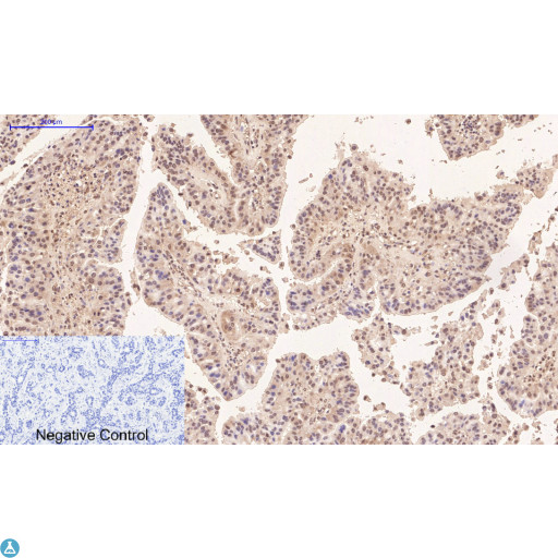 TUBG1 / Tubulin Gamma 1 Antibody - Immunohistochemical analysis of human lung cancer tissue. Anti-Gamma Tubulin at 1:200 (4°C, overnight). Antigen retrieval - Sodium Citrate pH6 (>98°C, 20min). Secondary - 1:200 (room temp, 30min). Negative control - Secondary only