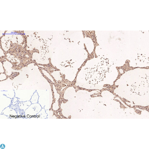 TUBG1 / Tubulin Gamma 1 Antibody - Immunohistochemical analysis of human stomach cancer tissue. Anti-Gamma Tubulin at 1:200 (4°C, overnight). Antigen retrieval - Sodium Citrate pH6 (>98°C, 20min). Secondary - 1:200 (room temp, 30min). Negative control - Secondary only