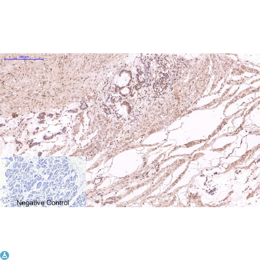 TUBG1 / Tubulin Gamma 1 Antibody - Immunohistochemistry (IHC) analysis of paraffin-embedded Human Breast Carcinoma Tissue using gamma Tubulin Mouse monoclonal antibody diluted at 1:200.