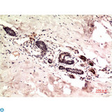 TUBG1 / Tubulin Gamma 1 Antibody - Immunohistochemistry (IHC) analysis of paraffin-embedded Human Colon Carcinoma Tissue using gamma Tutulin Mouse Monoclonal Antibody diluted at 1:200.