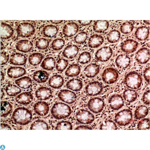 TUBG1 / Tubulin Gamma 1 Antibody - Immunohistochemistry (IHC) analysis of paraffin-embedded Human Colon Carcinoma Tissue using Gamma Tubulin Mouse Monoclonal Antibody diluted at 1:200.