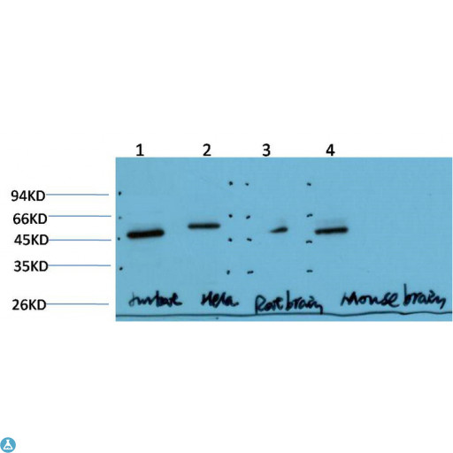 TUBG1 / Tubulin Gamma 1 Antibody - Immunohistochemistry (IHC) analysis of paraffin-embedded Human Breast Carcinoma Tissue using Gamma Tubulin Mouse Monoclonal Antibody diluted at 1:200.