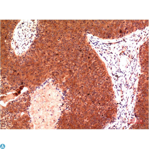 TUBG1 / Tubulin Gamma 1 Antibody - Immunohistochemistry (IHC) analysis of paraffin-embedded Human Breast Carcinoma Tissue using Gamma Tubulin Mouse Monoclonal Antibody diluted at 1:200.