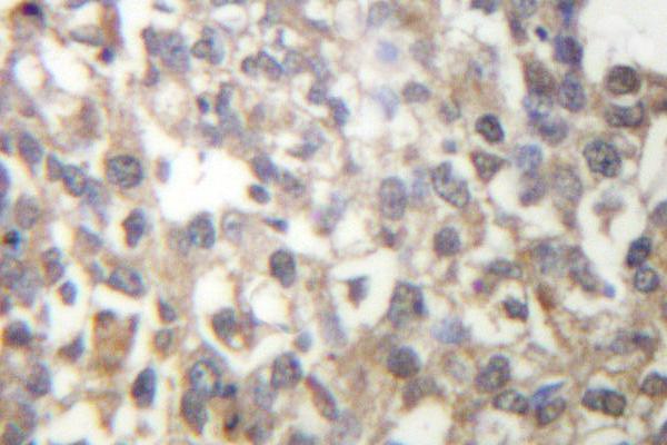 TUBG1 / Tubulin Gamma 1 Antibody - IHC of Tubulin (F414) pAb in paraffin-embedded human breast carcinoma tissue.