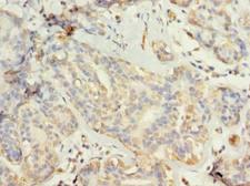 TUBG2 / Tubulin Gamma 2 Antibody - Immunohistochemistry of paraffin-embedded human breast cancer using antibody at dilution of 1:100.