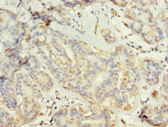 TUBG2 / Tubulin Gamma 2 Antibody - Immunohistochemistry of paraffin-embedded human breast cancer using TUBG2 Antibody at dilution of 1:100