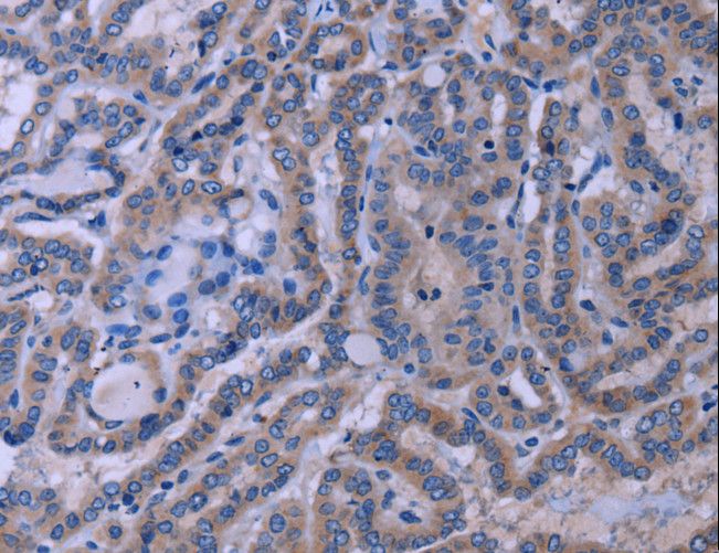 TUBGCP2 / GCP2 Antibody - Immunohistochemistry of paraffin-embedded Human thyroid cancer using TUBGCP2 Polyclonal Antibody at dilution of 1:50.
