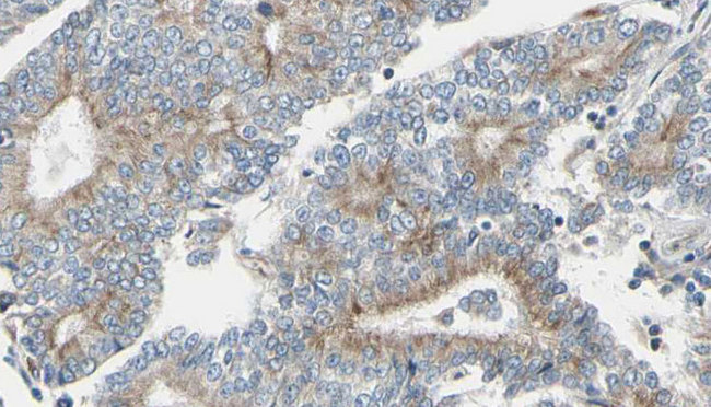 TUBGCP6 / GCP6 Antibody - 1:100 staining human prostate tissue by IHC-P. The sample was formaldehyde fixed and a heat mediated antigen retrieval step in citrate buffer was performed. The sample was then blocked and incubated with the antibody for 1.5 hours at 22°C. An HRP conjugated goat anti-rabbit antibody was used as the secondary.