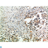 Tubulin Gamma Antibody - Immunohistochemical analysis of paraffin-embedded Human-breast-cancer, antibody was diluted at 1:100.