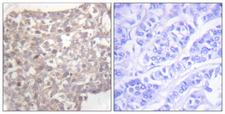 Tubulin Gamma Antibody - Peptide - + Immunohistochemistry analysis of paraffin-embedded human breast carcinoma tissue using Tubulin ? antibody.