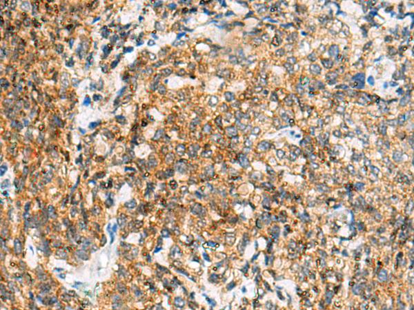 TUFT1 Antibody - Immunohistochemistry of paraffin-embedded Human cervical cancer tissue  using TUFT1 Polyclonal Antibody at dilution of 1:120(×200)
