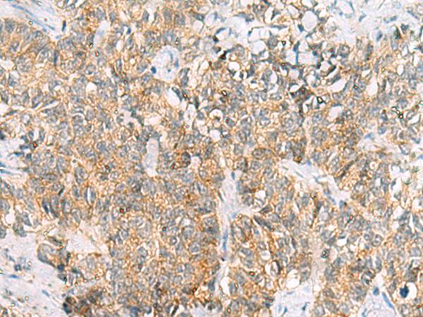 TUFT1 Antibody - Immunohistochemistry of paraffin-embedded Human ovarian cancer tissue  using TUFT1 Polyclonal Antibody at dilution of 1:120(×200)