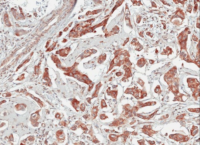 TULP1 Antibody - IHC of paraffin-embedded Breast CA using TULP1 antibody at 1:100 dilution.