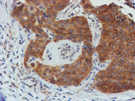 TULP3 Antibody - IHC of paraffin-embedded Carcinoma of Human lung tissue using anti-TULP3 mouse monoclonal antibody.