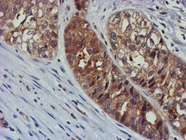 TULP3 Antibody - IHC of paraffin-embedded Adenocarcinoma of Human ovary tissue using anti-TULP3 mouse monoclonal antibody.