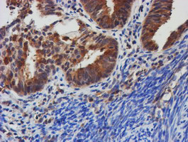 TULP3 Antibody - IHC of paraffin-embedded Adenocarcinoma of Human endometrium tissue using anti-TULP3 mouse monoclonal antibody.