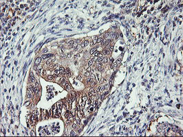 TULP3 Antibody - IHC of paraffin-embedded Carcinoma of Human pancreas tissue using anti-TULP3 mouse monoclonal antibody.