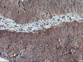 TULP3 Antibody - IHC of paraffin-embedded Carcinoma of Human bladder tissue using anti-TULP3 mouse monoclonal antibody.