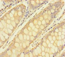 TULP3 Antibody - Immunohistochemistry of paraffin-embedded human colon cancer using TULP3 Antibody at dilution of 1:100