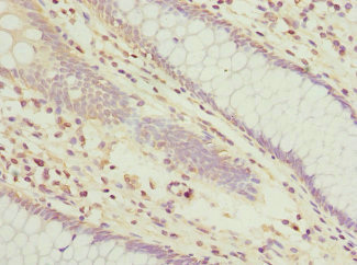 TUSC2 / FUS1 Antibody - Immunohistochemistry of paraffin-embedded human colon cancer at dilution 1:100