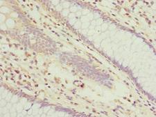 TUSC2 / FUS1 Antibody - Immunohistochemistry of paraffin-embedded human colon cancer at dilution 1:100