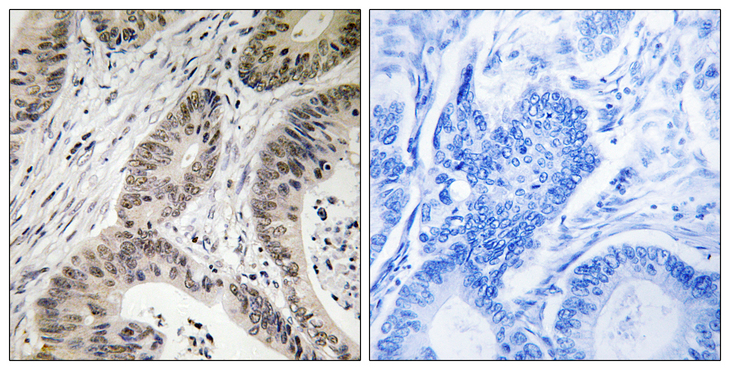 TUT1 Antibody - Immunohistochemistry analysis of paraffin-embedded human colon carcinoma, using TUT1 Antibody. The picture on the right is blocked with the synthesized peptide.