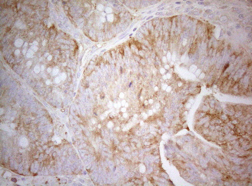 TWF1 / PTK9 Antibody - Immunohistochemical staining of paraffin-embedded Carcinoma of Human pancreas tissue using anti-TWF1 mouse monoclonal antibody. (Heat-induced epitope retrieval by 1mM EDTA in 10mM Tris buffer. (pH8.5) at 120°C for 3 min. (1:150)
