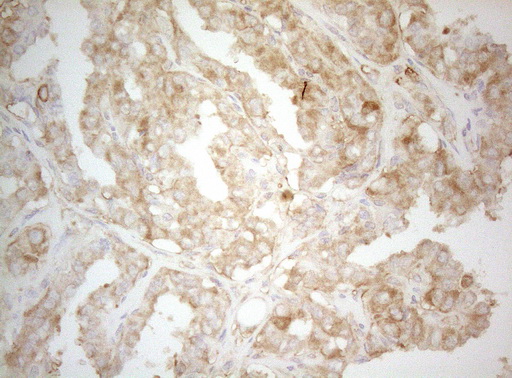 TWF1 / PTK9 Antibody - Immunohistochemical staining of paraffin-embedded Carcinoma of Human thyroid tissue using anti-TWF1 mouse monoclonal antibody. (Heat-induced epitope retrieval by 1mM EDTA in 10mM Tris buffer. (pH8.5) at 120°C for 3 min. (1:150)
