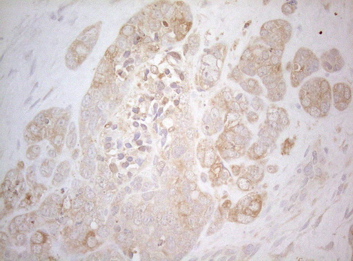 TWF1 / PTK9 Antibody - Immunohistochemical staining of paraffin-embedded Adenocarcinoma of Human endometrium tissue using anti-TWF1 mouse monoclonal antibody. (Heat-induced epitope retrieval by 1mM EDTA in 10mM Tris buffer. (pH8.5) at 120°C for 3 min. (1:150)
