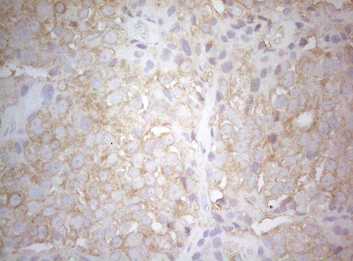 TWF1 / PTK9 Antibody - Immunohistochemical staining of paraffin-embedded Adenocarcinoma of Human breast tissue tissue using anti-TWF1 mouse monoclonal antibody. (Heat-induced epitope retrieval by 1mM EDTA in 10mM Tris buffer. (pH8.5) at 120°C for 3 min. (1:150)