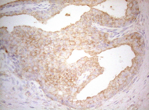TWF1 / PTK9 Antibody - Immunohistochemical staining of paraffin-embedded Carcinoma of Human prostate tissue using anti-TWF1 mouse monoclonal antibody. (Heat-induced epitope retrieval by 1mM EDTA in 10mM Tris buffer. (pH8.5) at 120°C for 3 min. (1:150)