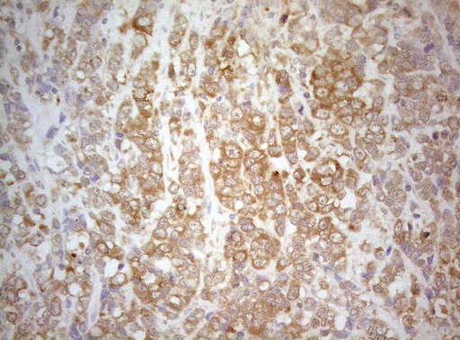 TWF1 / PTK9 Antibody - Immunohistochemical staining of paraffin-embedded Carcinoma of Human bladder tissue using anti-TWF1 mouse monoclonal antibody. (Heat-induced epitope retrieval by 1mM EDTA in 10mM Tris buffer. (pH8.5) at 120°C for 3 min. (1:150)
