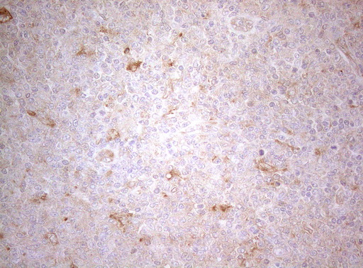 TWF1 / PTK9 Antibody - Immunohistochemical staining of paraffin-embedded Human lymphoma tissue using anti-TWF1 mouse monoclonal antibody. (Heat-induced epitope retrieval by 1mM EDTA in 10mM Tris buffer. (pH8.5) at 120°C for 3 min. (1:150)