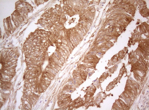TWF1 / PTK9 Antibody - Immunohistochemical staining of paraffin-embedded Adenocarcinoma of Human colon tissue using anti-TWF1 mouse monoclonal antibody. (Heat-induced epitope retrieval by 1mM EDTA in 10mM Tris buffer. (pH8.5) at 120°C for 3 min. (1:150)